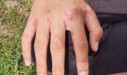 新南威尔士州四家医院爆发疥疮，38名患者感染